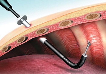 Thoracoscopy