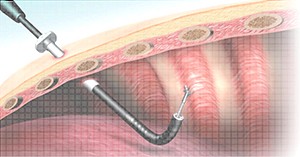 thoracoscopy