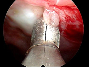 thoracoscopy