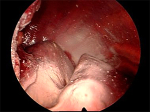 thoracoscopy