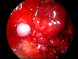 thoracoscopy
