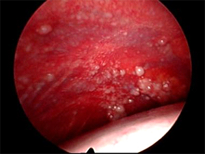 thoracoscopy
