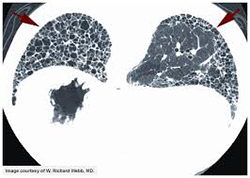 ILD Causes