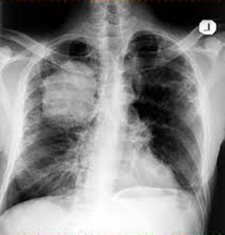 Lung Cancer Tests