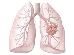 Lung Cancer Cause