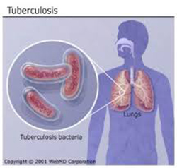 Pulmonary Tuberculosis