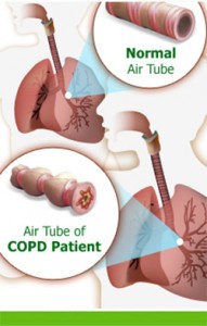 copd-191x300