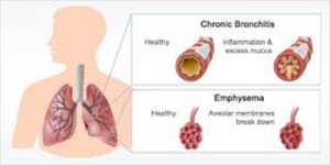 copd2-300x150